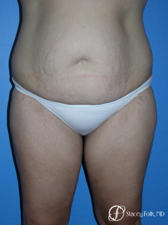Denver Tummy Tuck (Abdominoplasty) and Liposuction 10381 - Before Image 1