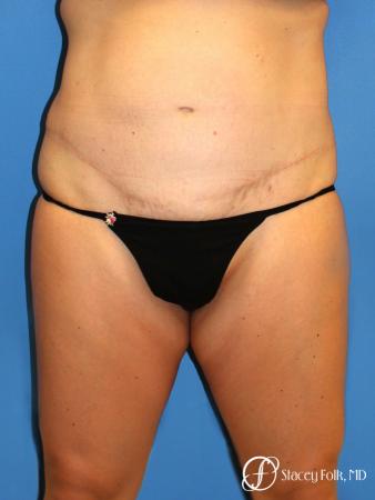 Denver Coolsculpting 8157 - Before Image 1