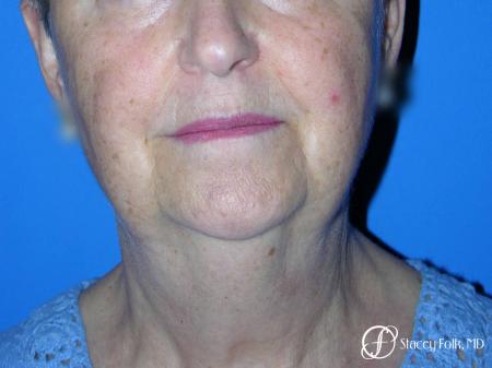 Denver Facial Rejuvenation Face Lift and Fat Injections 7130 - Before and After Image 2