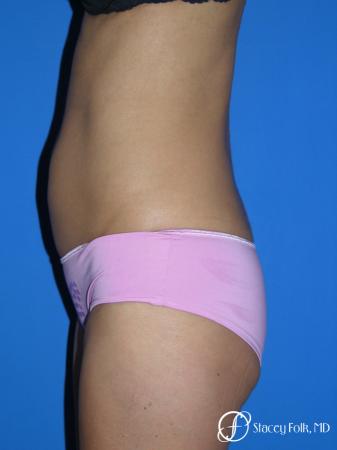 Denver Tummy Tuck Abdominoplasty 5609 - Before and After Image 3
