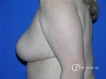 Denver Breast Reduction 16 - After Image 3