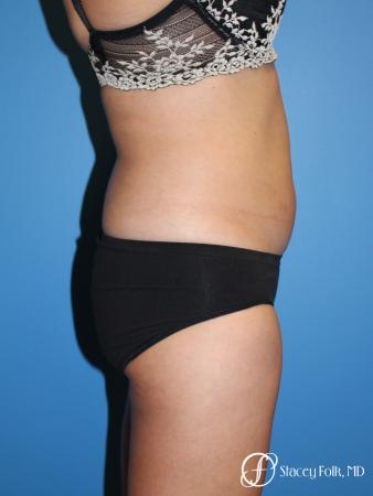 Liposuction - Before Image 1