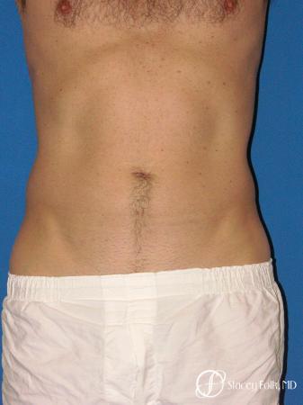 Denver Coolsculpting 5970 - After Image 1