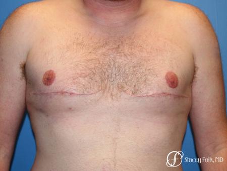Denver FTM Female to Male Top Surgery 7109 - After Image 1