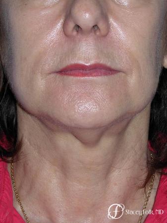 Denver Facial Rejuvenation Face Lift and Fat Injections 7117 - Before and After Image 3