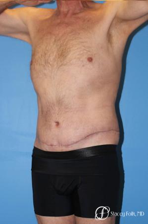 Denver Body Lift - Belt Lipectomy 8570 - After Image 3