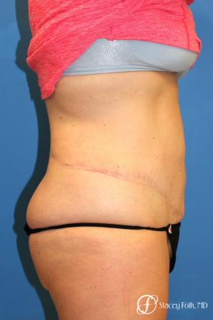 Denver Coolsculpting 8157 - Before and After Image 2