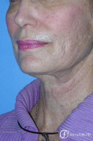 Denver Facial Rejuvenation Face Lift, Fat Injections, Laser Resurfacing 7116 - Before Image 2