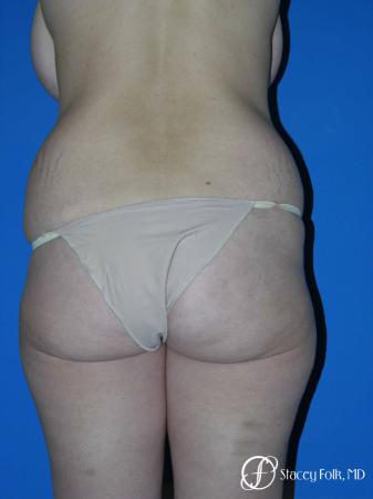 Denver Body Lift Belt lipectomy 5262 - Before Image 2