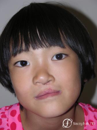 Denver Cleft Lip and Palate Repair 59 - After Image 2