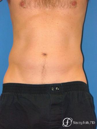Denver Coolsculpting 5970 - Before Image 1