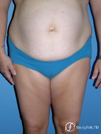 Denver Tummy Tuck - Abdominoplasty 7714 - Before Image 1