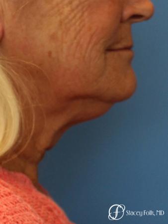 Facelift and Laser - Before Image 1