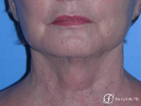 Denver Facial Rejuvenation Face Lift, Fat Injections, and Laser Resurfacing 7120 - After Image 3