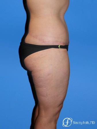 Denver Body Lift Belt lipectomy & liposuction 5264 - After Image 3