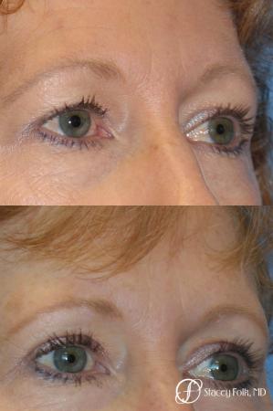 Denver Blepharoplasty 10316 - After Image 1