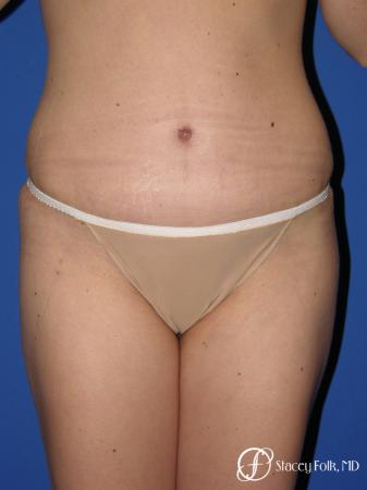 Denver Tummy Tuck - Abdominoplasty 10351 - After Image 1