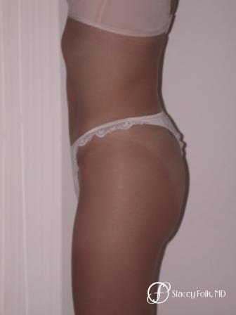 Denver Tummy Tuck 22 - After Image 2