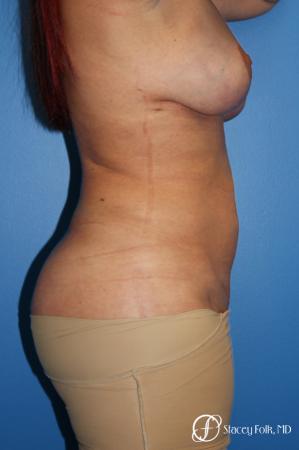 Denver Mommy Makeover 10298 - After Image 3