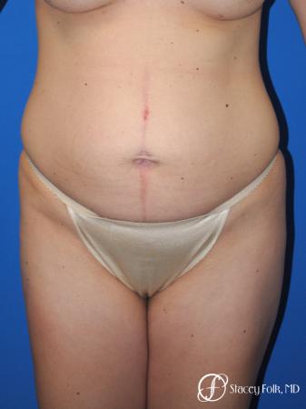 Denver Tummy Tuck - Abdominoplasty 10351 - Before Image 1