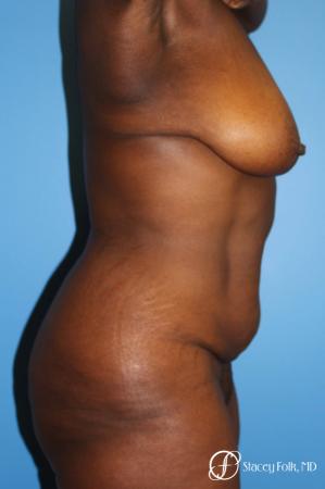 Denver Breast Lift - Mastopexy, and Tummy Tuck - Abdominoplasty 7512 - Before and After Image 4