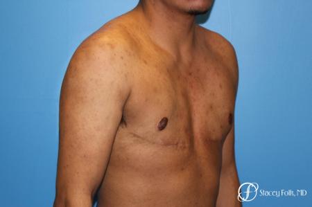 Denver FTM Female to male top surgery 5254 - After Image 2