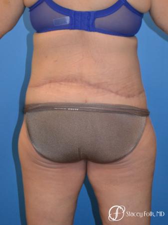 Denver Body Lift 4796 - After Image 2
