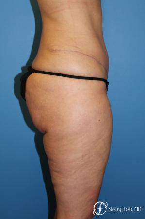 Tummy Tuck - Abdominoplasty - After Image 3