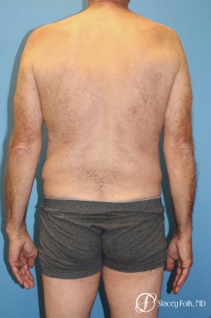Denver Body Lift - Belt Lipectomy 8570 - Before Image 2