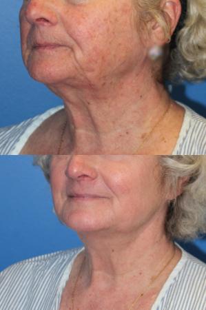 Denver J-Plasma Face Laser resurfacing with J-Plasma 10864 - After 1