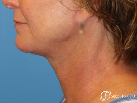 Denver Facial Rejuvenation Face Lift 7121 - After Image 1