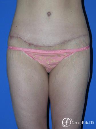 Denver Body Lift Belt lipectomy 5262 - After Image 1