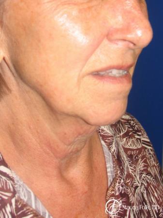 Denver Facial Rejuvenation Face Lift and Fat Injections 7129 - Before Image 2