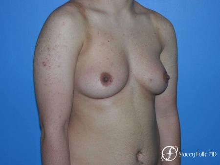 Denver FTM Female to male top surgery 5105 - Before Image 2