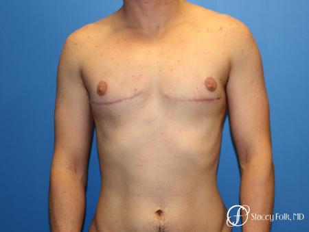 Denver FTM Female to male top surgery 6608 - After Image 1