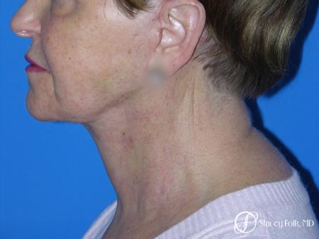 Denver Facial Rejuvenation Face Lift and Fat Injections 7130 - After Image 1