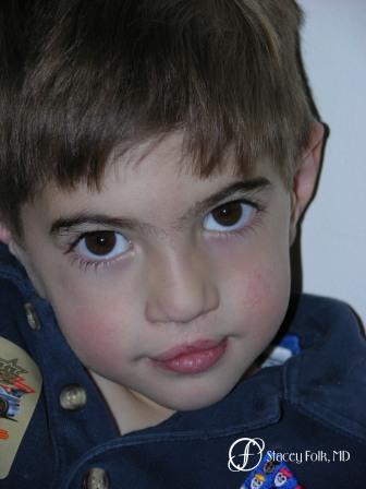 Denver Cleft Lip and Palate Repair 57 - After Image 1
