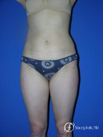 Denver Liposuction 961 - After Image 1