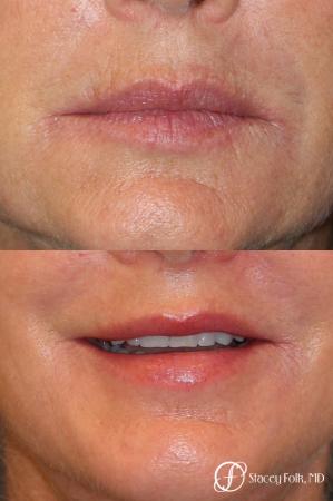 Denver Laser Skin Resurfacing Face 9390 - Before Image 1