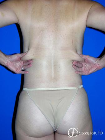 Denver Coolsculpting 8161 - After Image 2