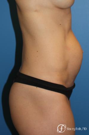 Denver Tummy Tuck (Abdominoplasty) 11239 - Before and After Image 5