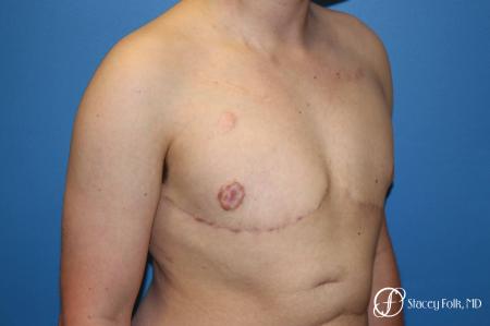Denver Female to Male Top Surgery 5257 - After Image 2