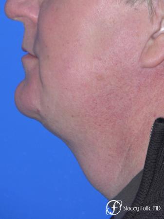 Denver Facial Rejuvenation Face lift, and Fat injections 7157 - After Image 1