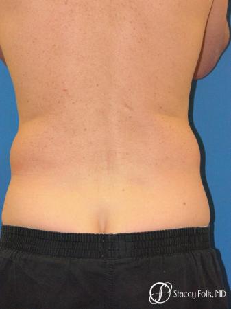 Denver Coolsculpting 5970 - Before Image 2