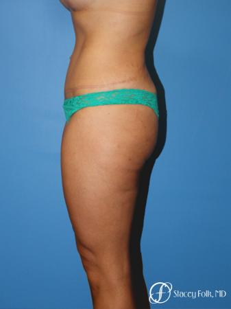 Denver Tummy Tuck Abdominoplasty 5368 - After Image 3