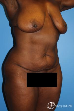Denver Breast Lift - Mastopexy, and Tummy Tuck - Abdominoplasty 7512 - Before Image 3