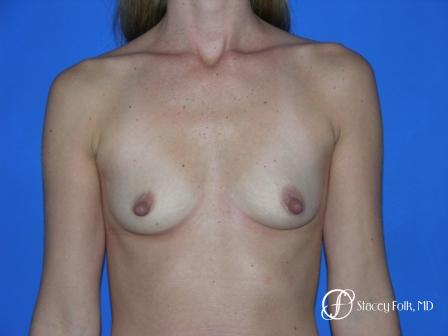 Denver Breast Augmentation 26 - Before Image 1