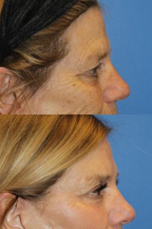 Denver Browlift and Blepharoplasty 11238 - After Image 2