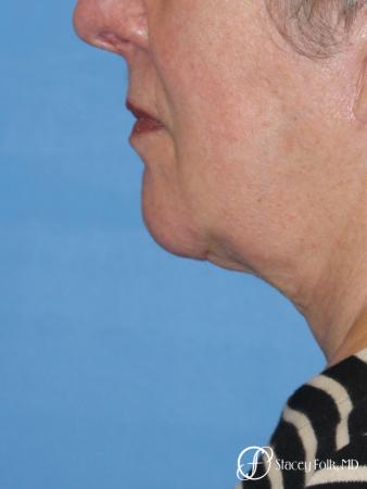 Denver Facial Rejuvenation Face and Neck Lift with Fat Transfer to the Face 9133 - After Image 1