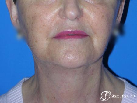 Denver Facial Rejuvenation Face Lift and Fat Injections 7130 - After Image 2